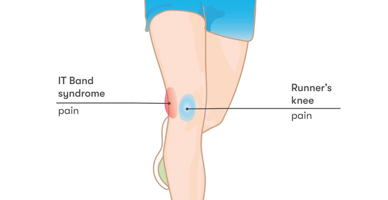 What is Iliotibial band syndrome · Get Better Physio