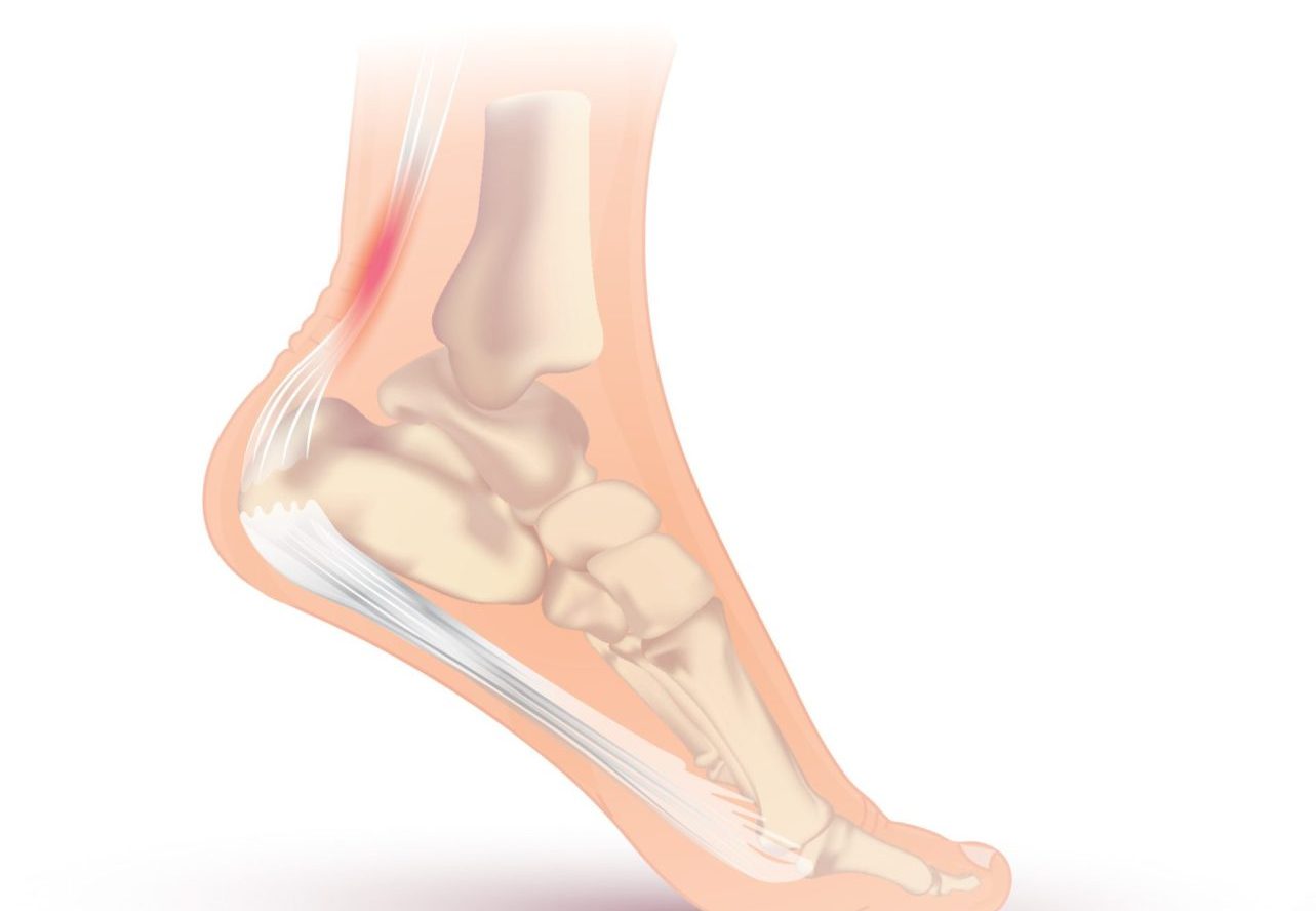 Is your heel pain caused by Haglund's Deformity? | TMA